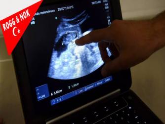 Bulantı ve karında şişlik gibi belirtiler nedeniyle hamile olduğunu düşünen bir kadın, yaptırdığı testler negatif çıkınca doktora başvurdu. Yapılan muayenelerde, kadının yumurtalıklarında futbol topu büyüklüğünde kist olduğu ortaya çıktı.